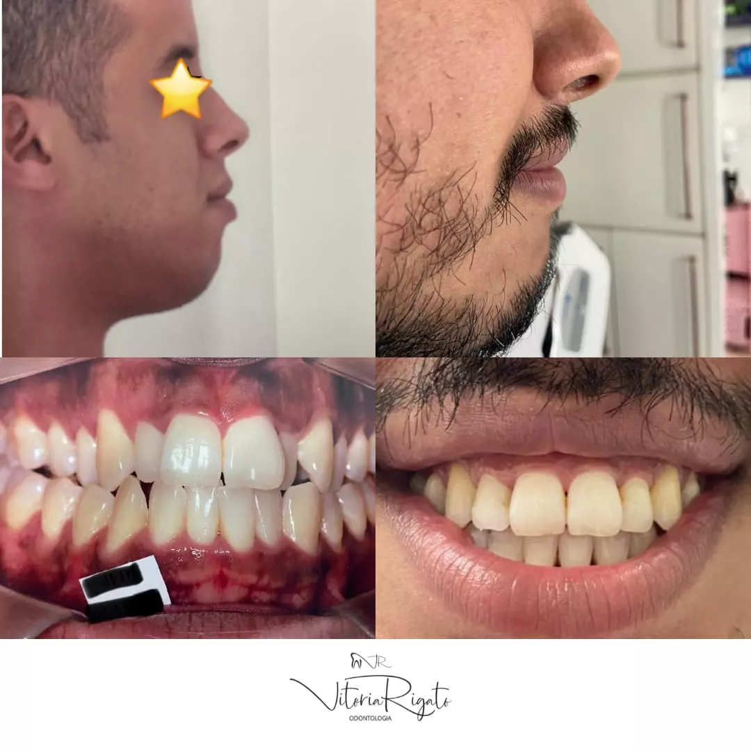 Alinhamento Ortodôntico Avançado (antes e depois)